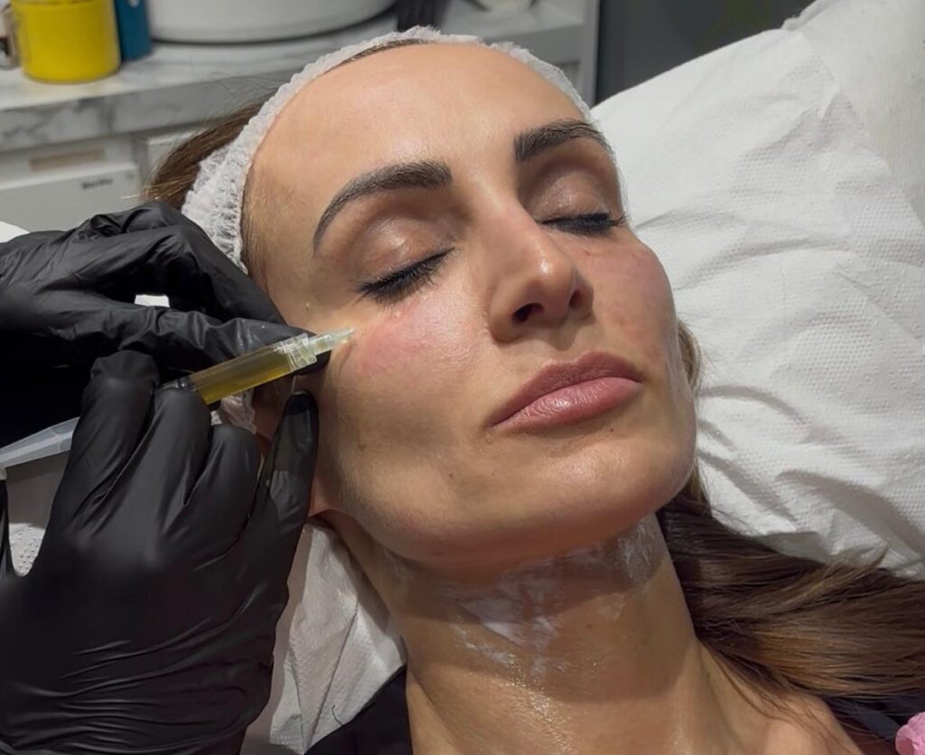 PRP Treatment