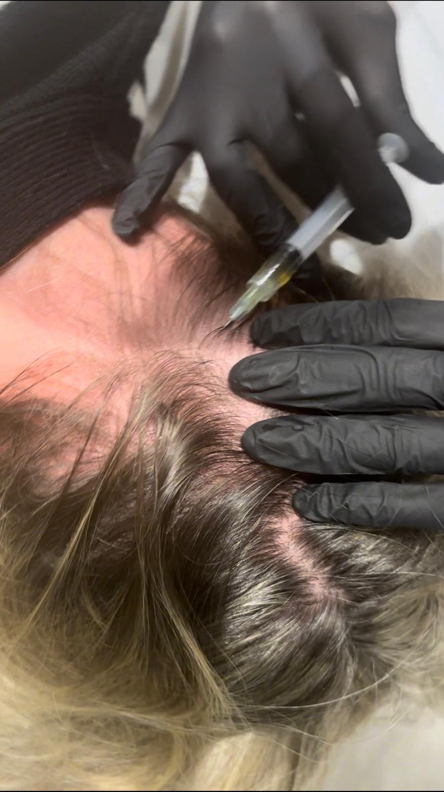 PRP & PRF Treatment5