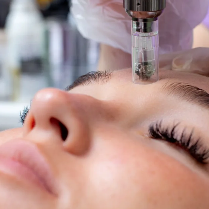 Fractional microneedle facial therapy close up